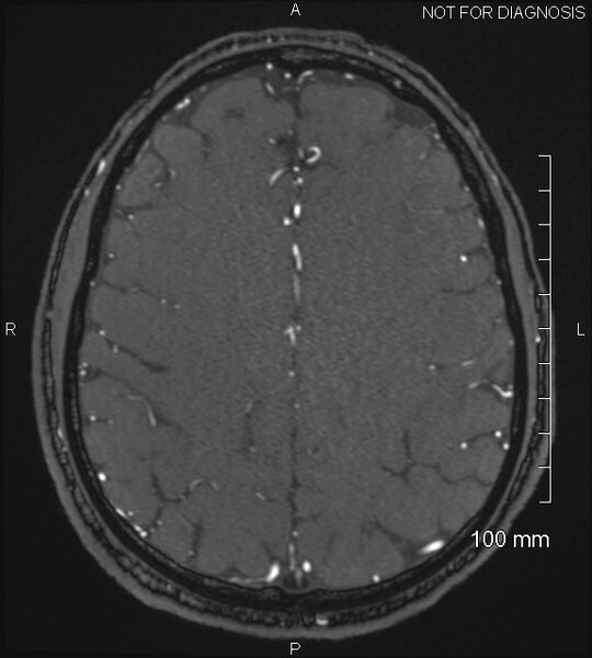 File:Anterior cerebral artery aneurysm (Radiopaedia 80683-94127 Axial MRA 176).jpg