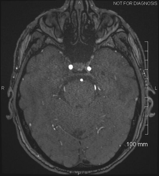 File:Anterior cerebral artery aneurysm (Radiopaedia 80683-94127 Axial MRA 77).jpg