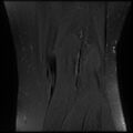 Anterior cruciate ligament tear, Wrisberg rip and bucket-handle tear of medial meniscus (Radiopaedia 75872-87266 Coronal PD fat sat 24).jpg