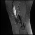 Anterior cruciate ligament tear, Wrisberg rip and bucket-handle tear of medial meniscus (Radiopaedia 75872-87266 Sagittal PD fat sat 2).jpg