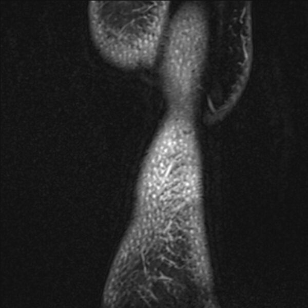 File:Anterior cruciate ligament tear - ramp lesion (Radiopaedia 71883-82322 Sagittal T1 vibe 1).jpg