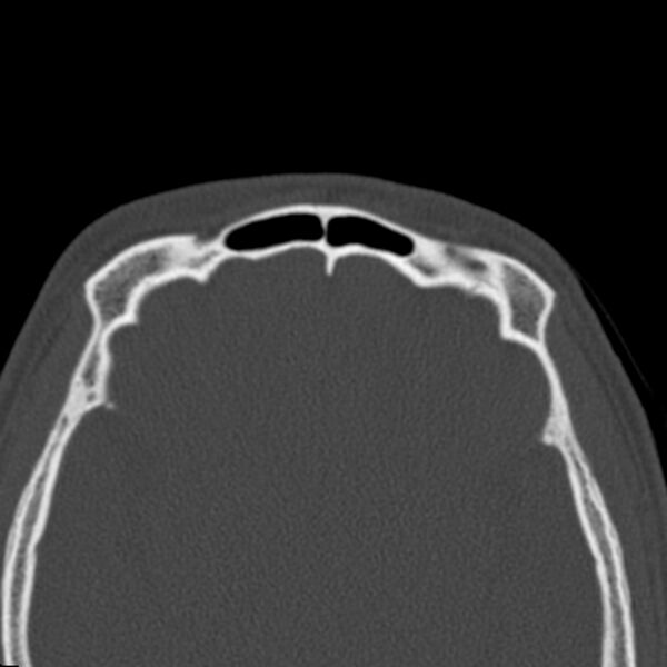 File:Antrochoanal polyp (Radiopaedia 21894-21868 Axial bone window 42).jpg