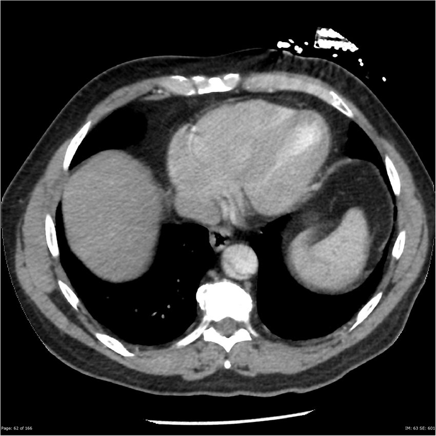 Aortic dissection- Stanford A (Radiopaedia 37759-39664 A 53).jpg