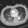 Aortic dissection - DeBakey type II (Radiopaedia 64302-73082 Axial lung window 35).png