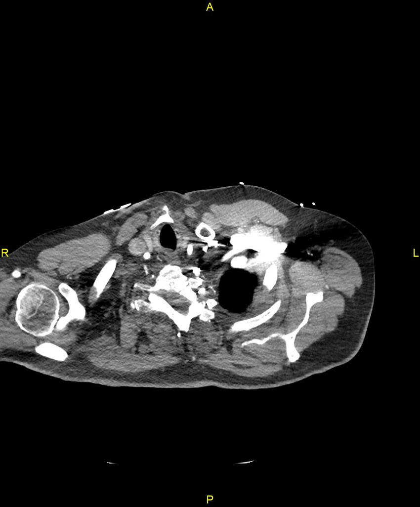 Aortic rupture (Radiopaedia 88822-105594 B 12).jpg