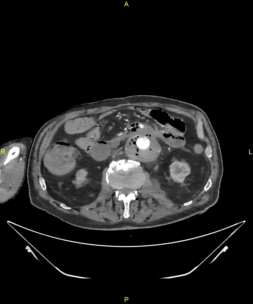 Aortoenteric fistula (Radiopaedia 84308-99603 B 161).jpg