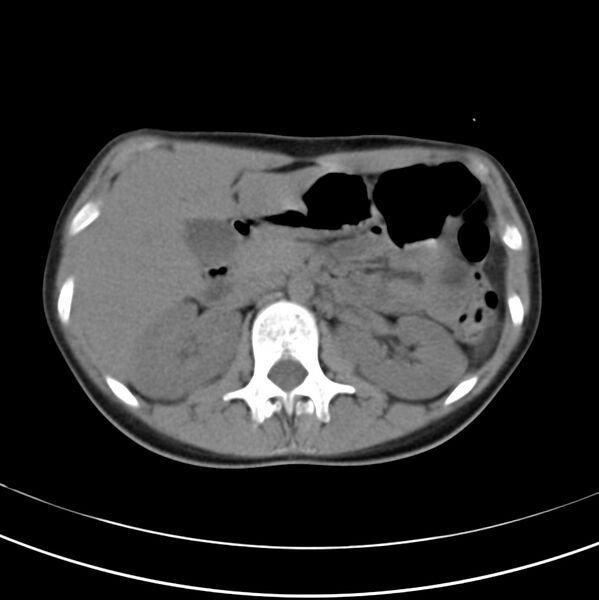File:Appendicitis and incidental bicornuate uterus (Radiopaedia 22833-22853 Axial non-contrast 15).jpg