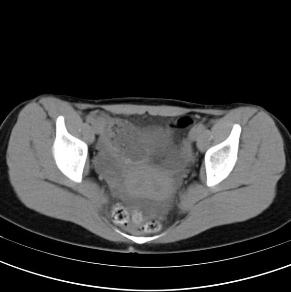 File:Appendicitis and incidental bicornuate uterus (Radiopaedia 22833-22853 Axial non-contrast 41).jpg