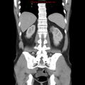 Appendicitis and renal cell carcinoma (Radiopaedia 17063-16760 B 23).jpg