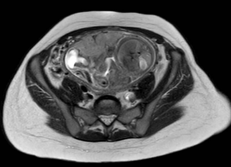 File:Appendicitis in gravida (MRI) (Radiopaedia 89433-106395 Axial T2 50).jpg