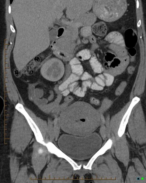 File:Appendicitis post recent cesarian section (Radiopaedia 29594-30102 D 14).jpg