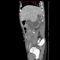 Appendicitis with phlegmon (Radiopaedia 9358-10046 F 15).jpg