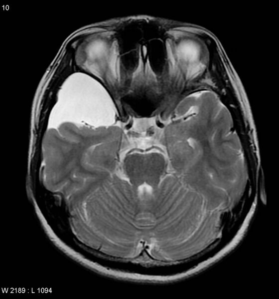 File:Arachnoid cyst - middle cranial fossa (Radiopaedia 4768-6774 Axial T2 1).jpg