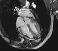 Arrhythmogenic right ventricular cardiomyopathy (Radiopaedia 39806-42237 D 15).jpg