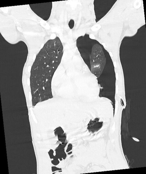 File:Arrow injury to the chest (Radiopaedia 85367-100975 Coronal lung window 60).jpg