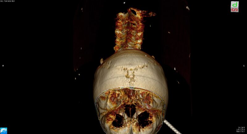 File:Arrow injury to the head (Radiopaedia 75266-86388 3D vertical 33).jpg