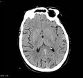 Arteriovenous malformation - cerebral (Radiopaedia 8172-9020 Axial non-contrast 11).jpg