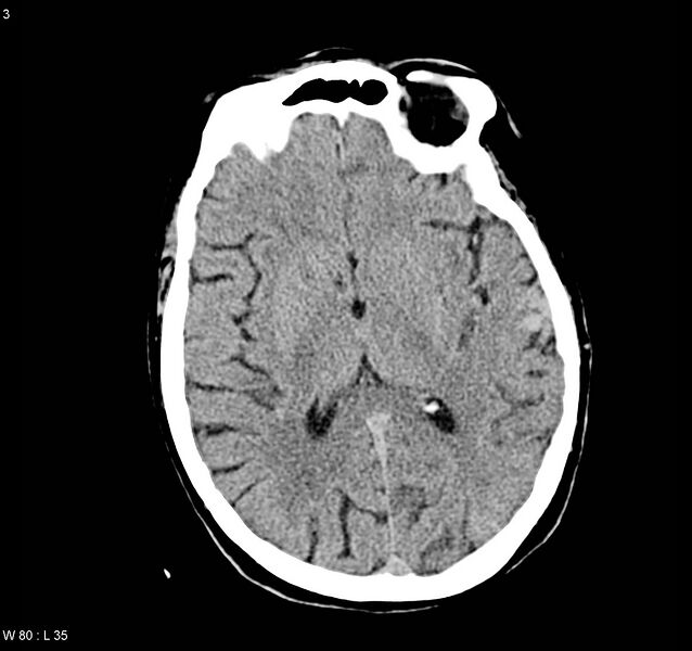 File:Arteriovenous malformation - cerebral (Radiopaedia 8172-9020 Axial non-contrast 11).jpg