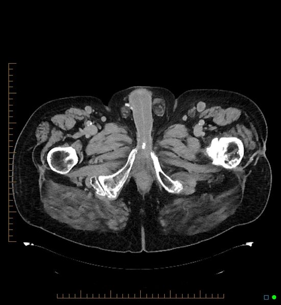 File:Artificial urethral sphincter (Radiopaedia 46937-51464 A 13).jpg