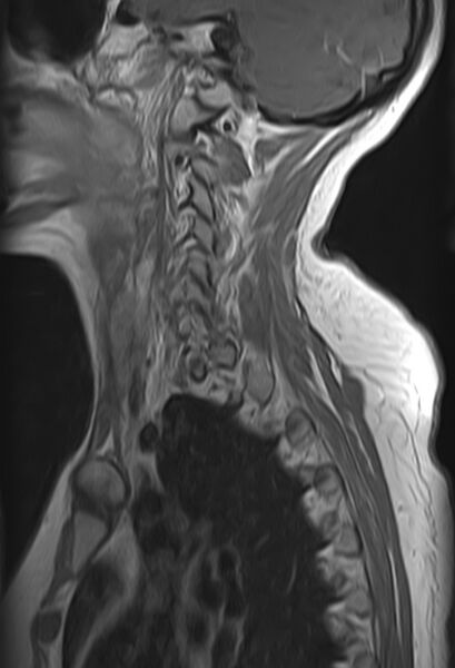 File:Astrocytoma - spinal cord (Radiopaedia 69769-79758 Sagittal T1 C+ 2).jpg