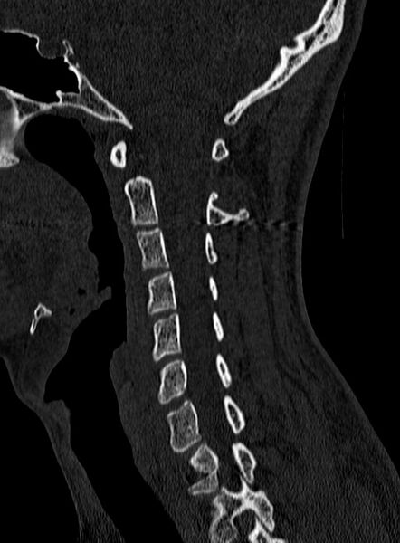 File:Atlantoaxial subluxation (Radiopaedia 44681-48450 Sagittal bone window 55).jpg