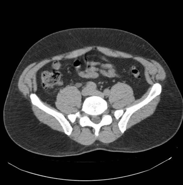 File:Atrophic kidney due to severe chronic obstructive hydronephrosis (Radiopaedia 40828-43474 Axial non-contrast 26).jpg