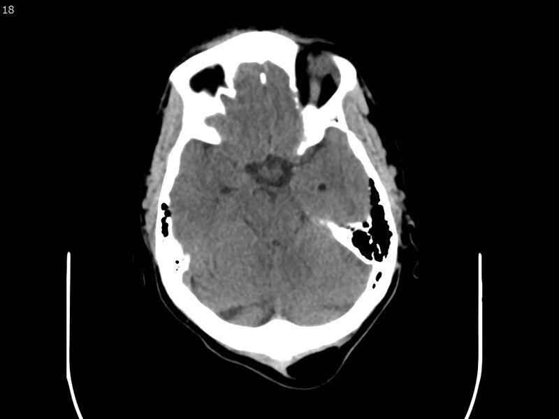 File:Atypical meningioma - intraosseous (Radiopaedia 64915-73867 A 18).jpg