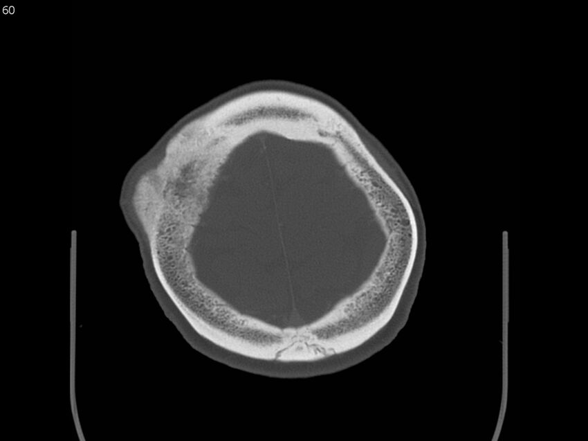 Atypical meningioma - intraosseous (Radiopaedia 64915-73867 Axial C+ bone window 60).jpg