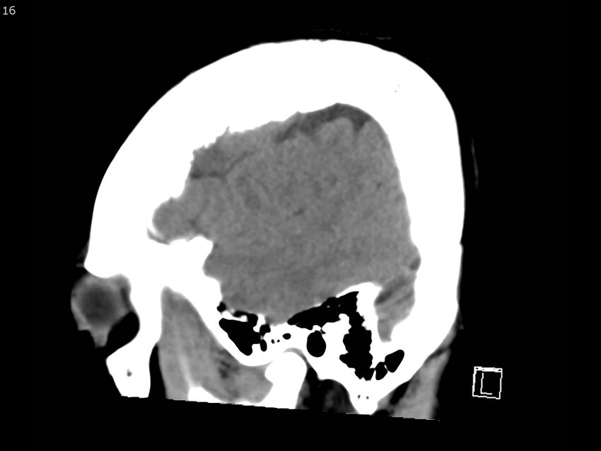 Atypical meningioma - intraosseous (Radiopaedia 64915-73867 C 14).jpg