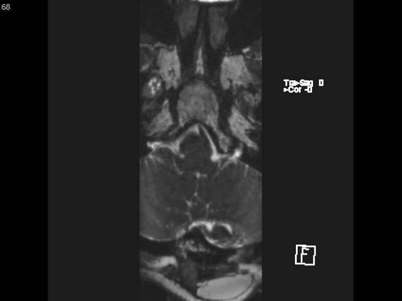 File:Atypical meningioma - intraosseous (Radiopaedia 64915-74572 Axial CISS 68).jpg