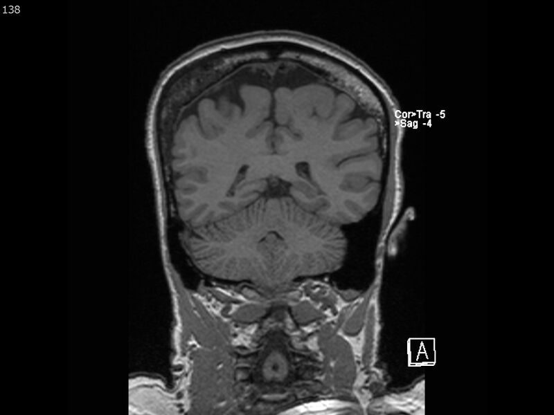 File:Atypical meningioma - intraosseous (Radiopaedia 64915-74572 Coronal T1 138).jpg