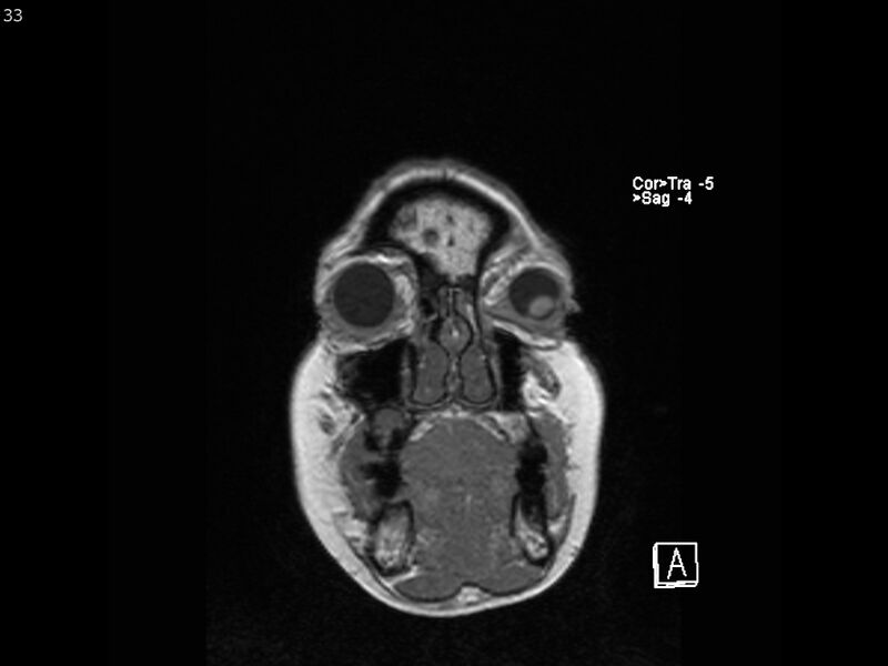 File:Atypical meningioma - intraosseous (Radiopaedia 64915-74572 Coronal T1 33).jpg