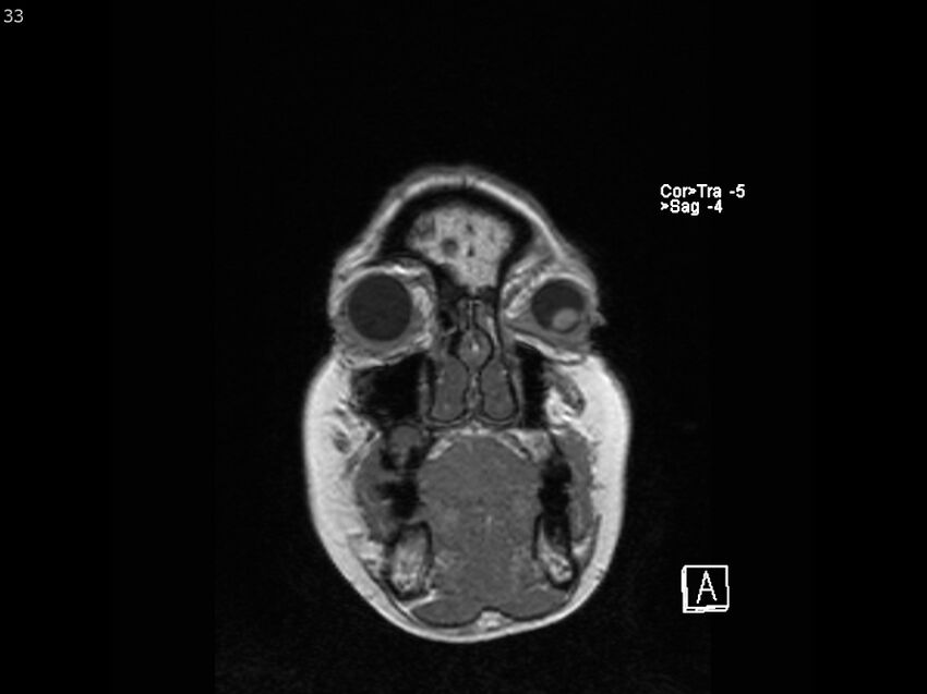 Atypical meningioma - intraosseous (Radiopaedia 64915-74572 Coronal T1 33).jpg
