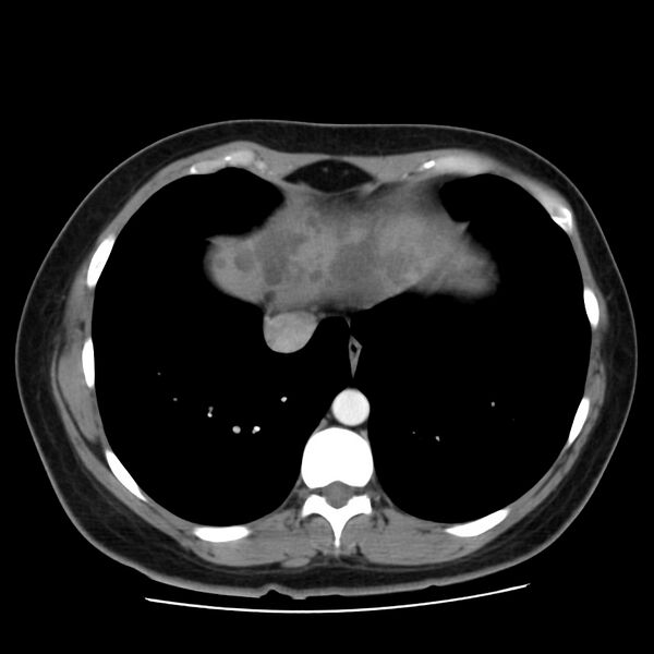 File:Autosomal dominant polycystic kidney disease (Radiopaedia 23061-23093 B 6).jpg
