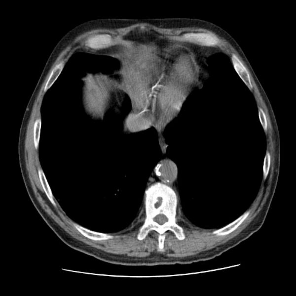 File:Autosomal dominant polycystic kidney disease (Radiopaedia 27851-28094 Axial non-contrast 44).jpg