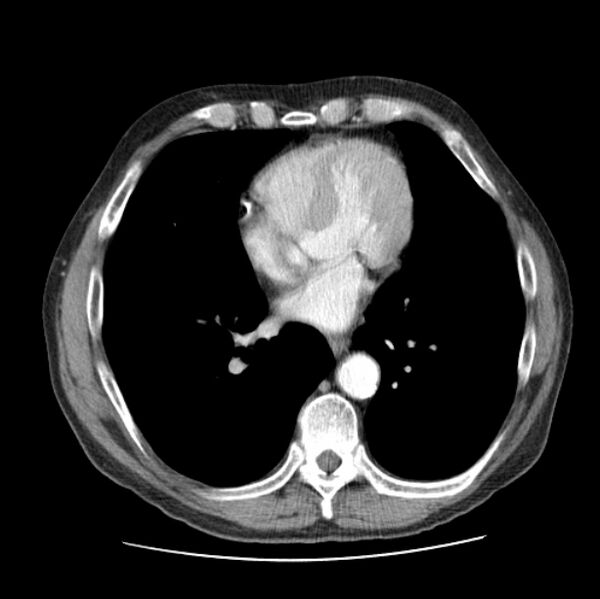 File:Autosomal dominant polycystic kidney disease (Radiopaedia 27851-28094 B 38).jpg