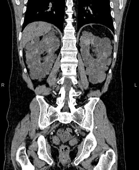 File:Autosomal dominant polycystic kidney disease (Radiopaedia 87830-104287 Coronal non-contrast 46).jpg