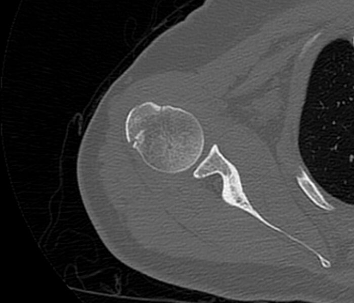 File:Avulsion fracture - greater tuberosity of humerus (Radiopaedia 71216-81514 Axial bone window 35).jpg