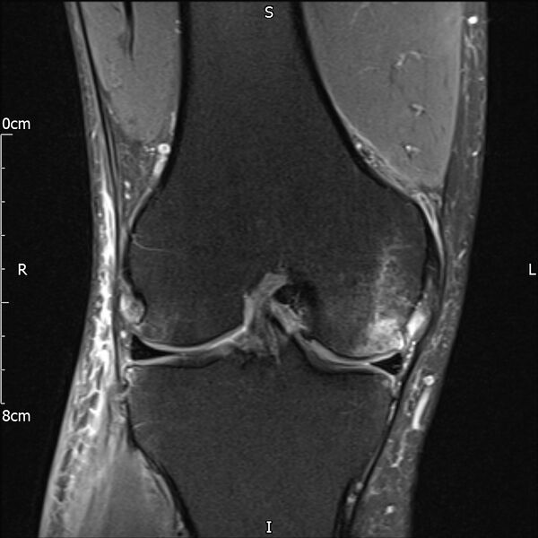 File:Avulsion fracture of the fibular head (Radiopaedia 74804-85808 Coronal PD fat sat 20).jpg