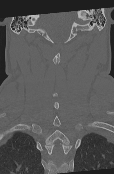 File:Axis peg fracture (type 3) and atlas lateral mass (type 4) fracture (Radiopaedia 37474-39324 Coronal bone window 42).png