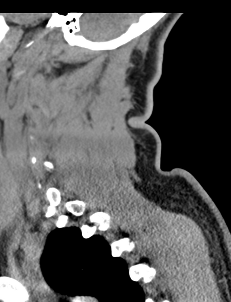 File:Axis peg fracture (type 3) and atlas lateral mass (type 4) fracture (Radiopaedia 37474-39324 D 60).png