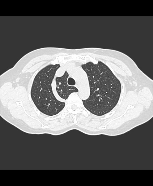 File:Azygos fissure and azygos lobe (Radiopaedia 41841-44832 Axial lung window 25).jpg