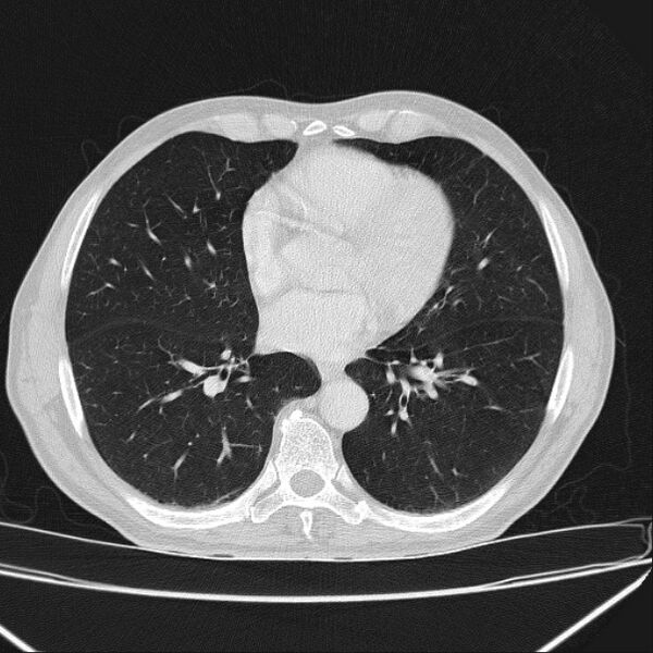 File:Azygos lobe (Radiopaedia 38259-40275 Axial lung window 50).jpg