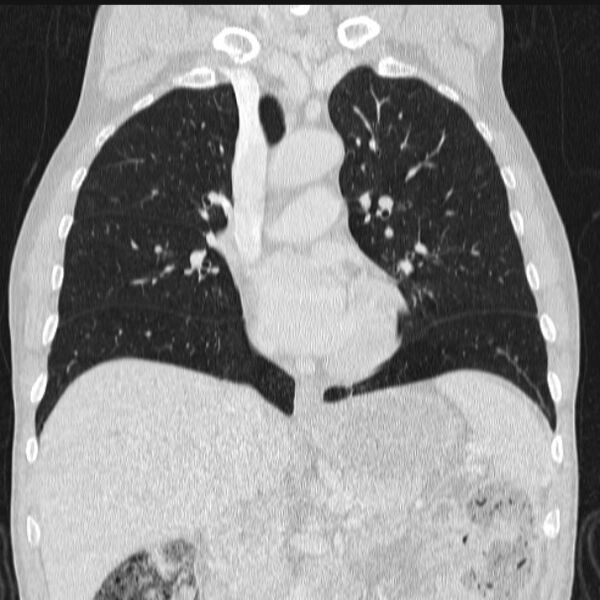 File:Azygos lobe (Radiopaedia 38259-40275 Coronal lung window 37).jpg