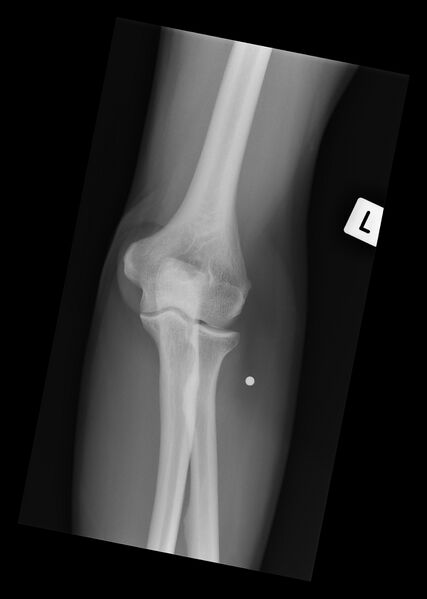 File:BB (ball bearing) bullet within the soft tissues of the forearm (Radiopaedia 44382-48017 Frontal 1).jpg