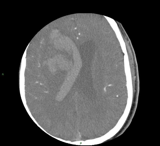 File:Basal ganglia hemorrhage (Radiopaedia 58763-65985 D 118).jpg
