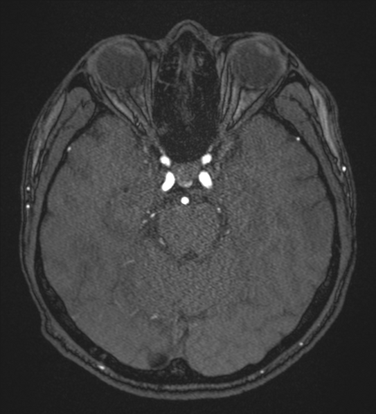 File:Basal ganglia subacute infarct (Radiopaedia 80201-93521 Axial MRA 41).png