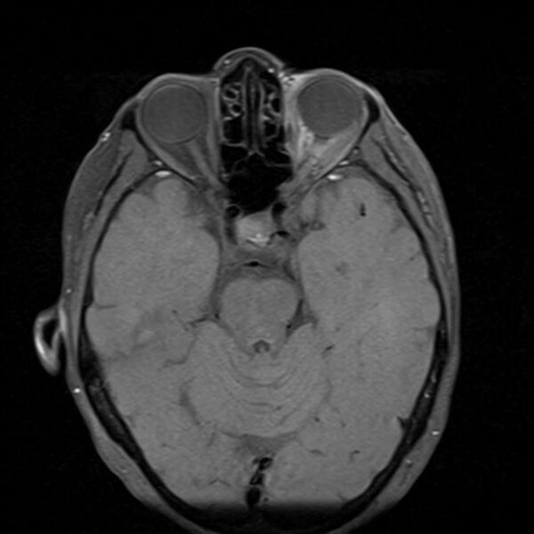 File:Base of skull chondrosarcoma (Radiopaedia 30410-31070 Axial T1 fat sat 13).jpg