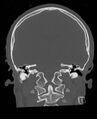 Base of skull fracture with bilateral Le Fort fractures (Radiopaedia 47094-51638 Coronal bone window 42).jpg
