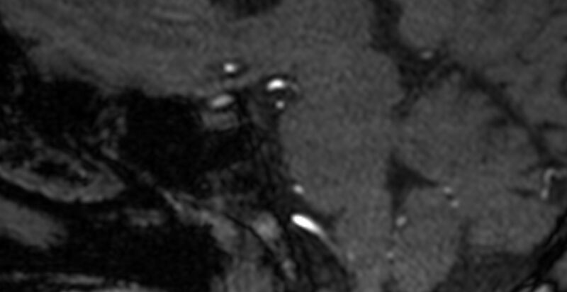 File:Basilar artery fenestration (Radiopaedia 74537-85455 Sagittal MRA TOF 31).jpg